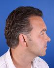 After Hair Transplant&nbsp;Temporal Hairline